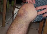 Mi lesión: Esguince de rodilla