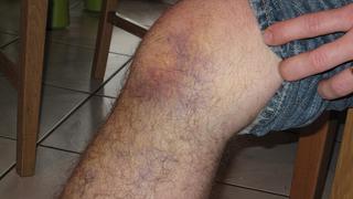 Mi lesión: Esguince de rodilla
